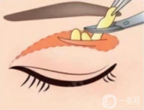 眼部熱瑪吉注意事項(xiàng)