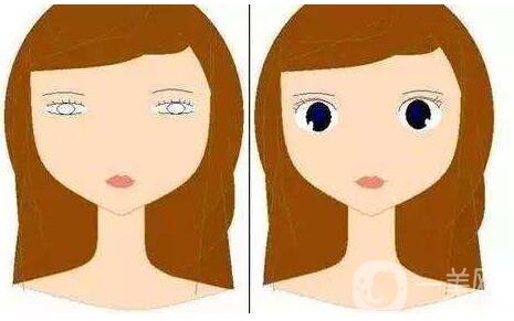 上瞼下垂矯治術(shù)*果怎么做 保持多久？