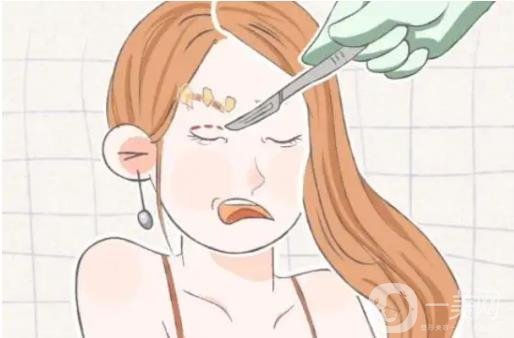 開眼角手術前后圖 開眼角注意事項