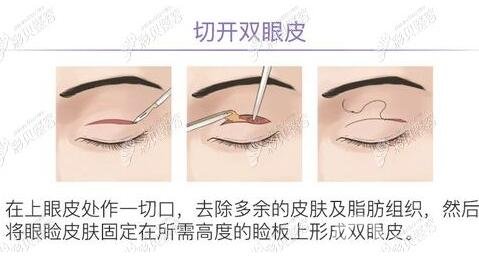 超聲波去眼袋多少錢,超聲波去眼袋*果