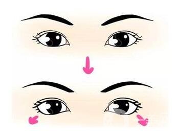 開外眼角前后 開外眼角手術*果怎么樣？