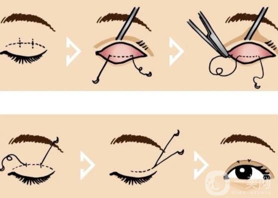 南醫(yī)大二附院割雙眼皮多少錢？整形價格表及術(shù)后*果圖一覽