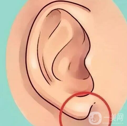 玻尿酸注射豐耳垂要注意什么？術(shù)后護(hù)理詳細(xì)介紹