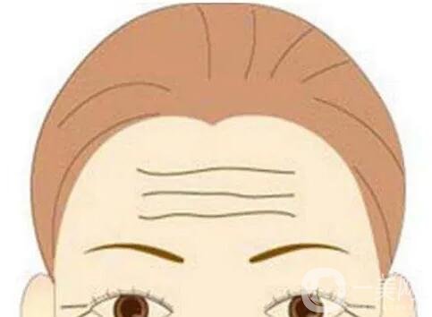 去掉抬頭紋要多少錢？