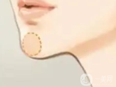 墊下巴術(shù)前準(zhǔn)備有什么呢？