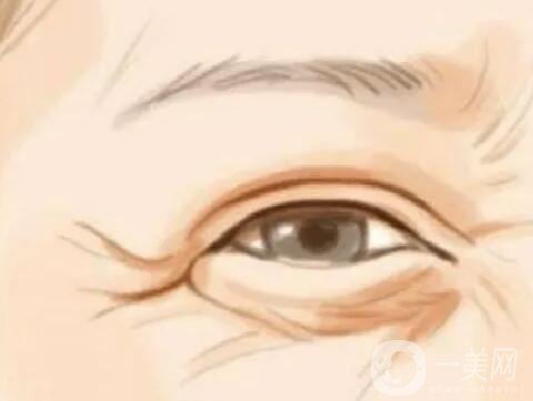 去除魚尾紋方法有哪些 注射玻尿酸*果好嗎？