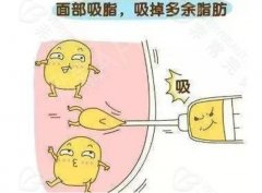 成都面部吸脂多少錢?價(jià)格影響因素大盤點(diǎn)