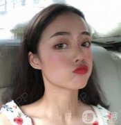 時(shí)間過得還真是快呀，我已經(jīng)熬過了前兩周，現(xiàn)如今植發(fā)的部位有一些癢