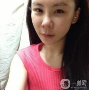 因為我自己身上的脂肪不是太多，所以醫(yī)生看到我這樣的面部直接給我推薦的是