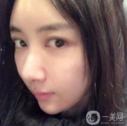 做完面部填充手術已經(jīng)半年的時間了，現(xiàn)在我的臉部脂肪已經(jīng)穩(wěn)定下來了