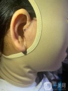 做拉皮手術(shù)的這件事情，也是經(jīng)過我深思熟慮的，我去了三家醫(yī)院進行了面診