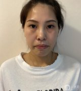 做完皮秒，我的臉白得像個(gè)帶殼的雞蛋，激動(dòng)~