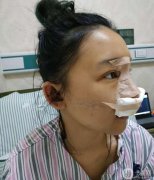 總覺得鼻子眼睛真的需要改良，鼻子不明顯，所以做了手術(shù)