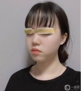 我是懶癌患者，據(jù)說貼雙眼皮貼不好，我的眼皮很容易松弛，權(quán)衡利弊，還是割