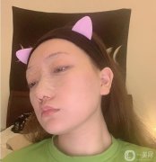 今天是術(shù)后第七天，縫線已經(jīng)拆線，醫(yī)生說恢復(fù)的不錯