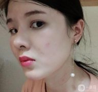 臉部的腫脹在慢慢減輕，淤青也在消失，越來越正常