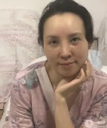 鼻子和面部提升都恢復(fù)的很好