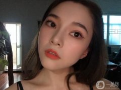 滿月打卡!30天恢復，鼻子還是很好的，鼻型和鼻腔的切口都很好，沒有異常不適