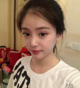 拆線后拍了照，鼻子還是有點(diǎn)腫，但是鼻子的形狀自然多了