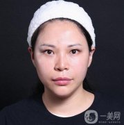 做完面部拉皮手術(shù)的第2天，臉上有強烈的緊繃感覺