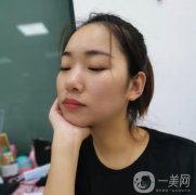 做完拉皮手術(shù)之后，還有些瘦臉型的效果