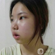 做了面部拉皮手術(shù)之后，感覺(jué)自己又回到了20歲的時(shí)候的肌膚