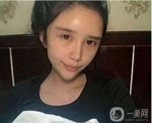 面部脂肪填充后，臉看起來(lái)很豐滿(mǎn)立體度有所提升