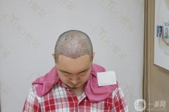 5月20號給自己買了禮物，就是做了植發(fā)手術