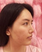 只要吃辣的，就容易長(zhǎng)痘，但是，我是那種極度不聽(tīng)話(huà)的人