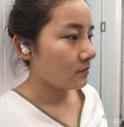 經(jīng)過一番思考，我終于決定做鼻子整形手術(shù)