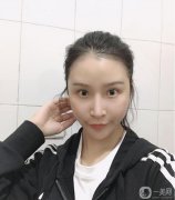 減脂很難，也瘦不了多少，所以面部吸脂真的幫了我很多