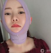我在下部做了吸臉和線雕，解決了臉上脂肪厚度和皮脂下垂的問題