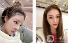 現(xiàn)在鼻子弧度還是很好的，山根自然消失，在原來的基礎上增加1 mm以上