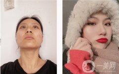 當我做完眼部手術后，我會在打洗臉，而不是像往常一樣