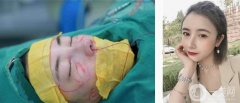 隆鼻、面部填充已經快一個月了，現(xiàn)在鼻子恢復情況比前兩周好了很多