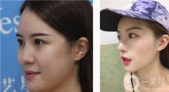 鼻子很別扭，首先我的鼻孔不對稱，鼻梁還很低