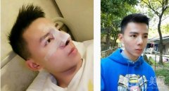 來醫(yī)院面診后，醫(yī)生給我做鼻子合成的建議，腫脹的耳軟骨墊托起了鼻子鼻頭縮