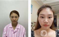 埋線雙眼皮手術(shù)后，我覺得每天照鏡子成了我不可或缺的例行公事