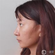 做完雙眼皮手術(shù)已經(jīng)好幾天了