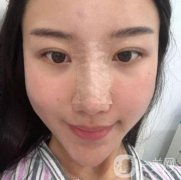 這個(gè)丑鼻子降低了我的面值，我想做手術(shù)