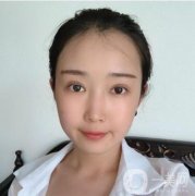 不得不說(shuō)雙眼皮的變化還是很大的