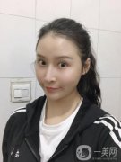 我早就想做面部吸脂了，我去過(guò)很多家，也咨詢(xún)過(guò)醫(yī)院