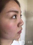 現(xiàn)在我的鼻子很豎立，鼻梁的位置比以前窄了很多