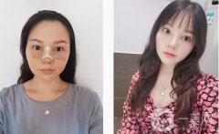 鼻梁很低，鼻翼很寬，從正面和側(cè)面看，這都是一個合適的塌鼻子