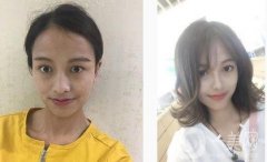 鼻子本身不太好看，一直想做鼻子，但是因?yàn)槭莻€很糾結(jié)的人，一直糾結(jié)