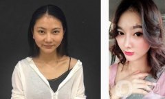 比如我的鼻子，我的鼻子，我的鼻梁都比較低，但是從正面看沒(méi)有問(wèn)題，但是從