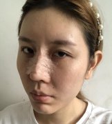 在網(wǎng)上查了很多隆鼻的資料，看到了各種鼻子類型