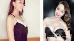 假體隆胸后一個月，現(xiàn)在有了漂亮性感的乳房，穿性感吊帶就沒壓力了