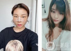 隆鼻第一天，迫不及待的想和大家分享