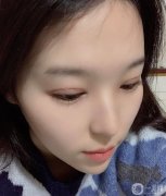 。手術(shù)前我是單眼皮純，沒有雙眼皮的痕跡，我一直夢(mèng)想如果我有雙眼皮
